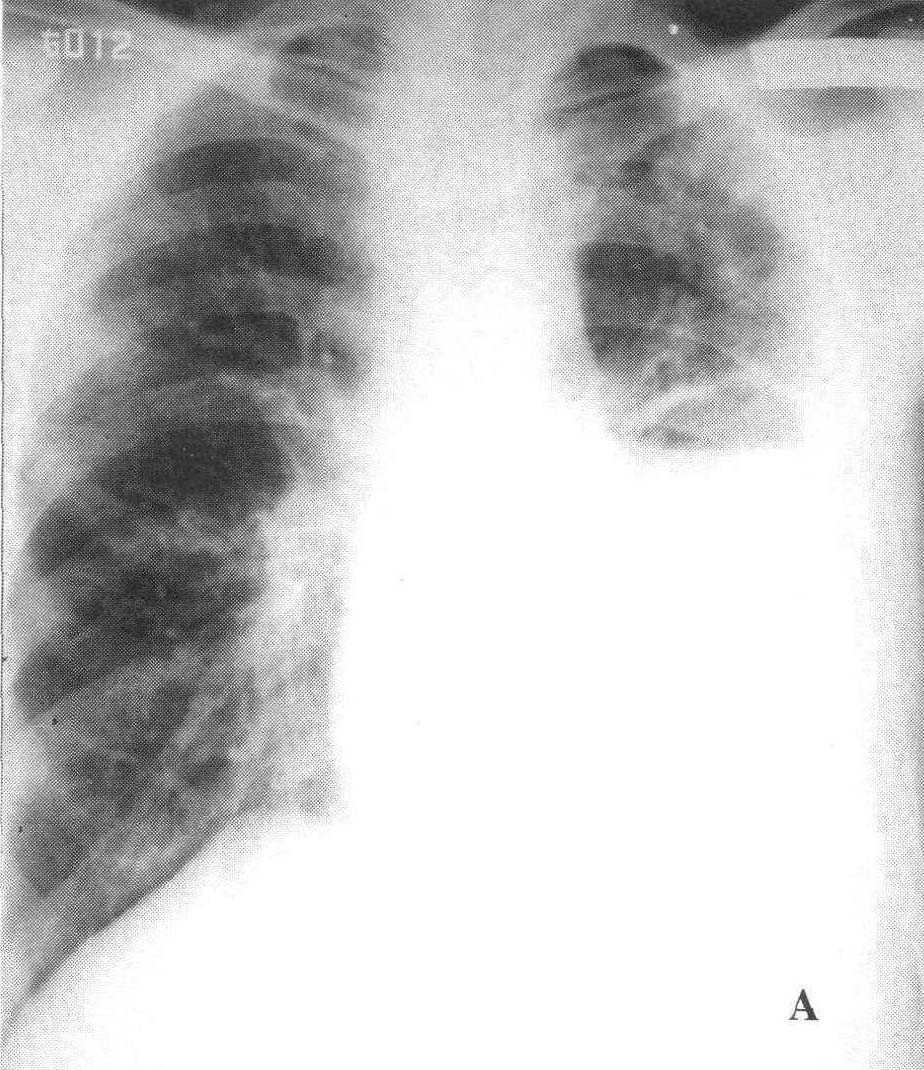 图2—30 支气管胸膜瘘